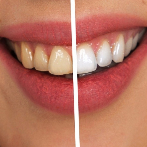 Clareamento Dental